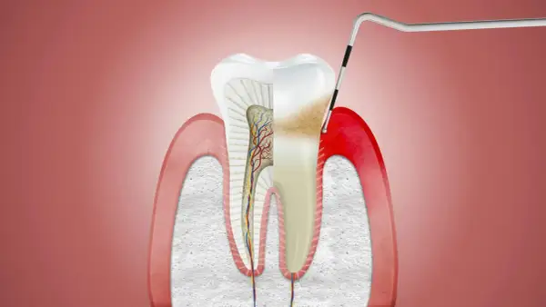 Przekrój zęba z widocznym zapaleniem dziąseł i narzędziem dentystycznym.