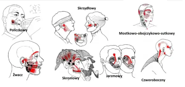 Ilustracje pokazują punkty bólu związane z różnymi mięśniami głowy i szyi, pomocne w zrozumieniu domowych sposobów na ból stawu skroniowo-żuchwowego.