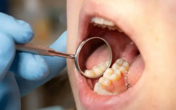 Usta otwarte, dentysta w rękawiczce bada zęby lusterkiem. Widać zdrowe, białe zęby, bez próchnicy.